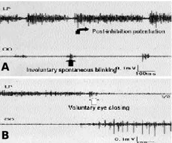 Figure 2. Synchronous EMG from levator palpebrae(LP) and orbicularis oculi(OO) during attack