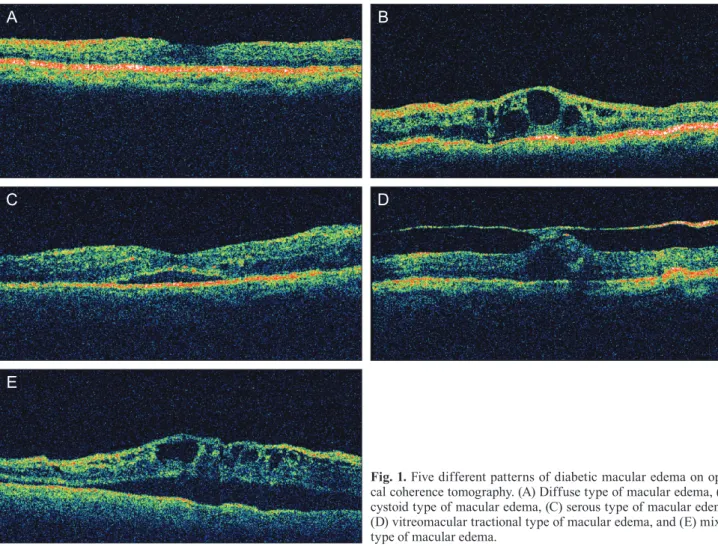 Fig. 1. Five different patterns of diabetic macular edema on opti- opti-cal coherence tomography