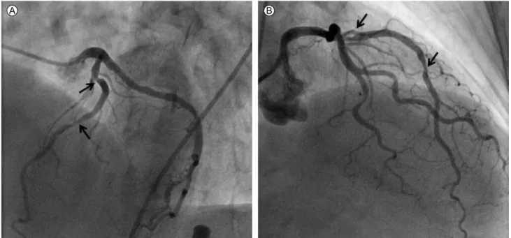 Figure 1. On pre-intervention angiography, (A) the left anterior oblique cranial view shows stenotic lesions in the proximal and middle  left anterior descending artery, and (B) the right anterior oblique cranial view shows a significant stenotic lesion (a