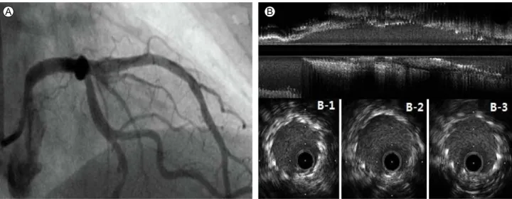 Figure 3. (A) A final angiogram, right anterior oblique cranial view. (B) Longitudinal IVUS images of the proximal LAD after additional  stent implantation