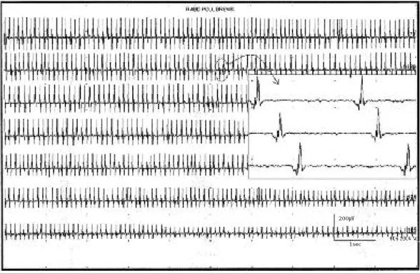Figure 1. EMG of the abductor pollicis brevis muscle.(At 3.5 weeks after symptoms onset) There were the form of trains of motor unit action potential-like discharges, which was induced by needle insertion and slight touch of the muscle, and which lasted 2~