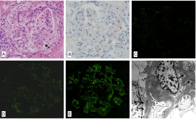 Figure 1. A representative renal biopsy specimen showing activation of the lectin pathway in lupus nephritis (case  No