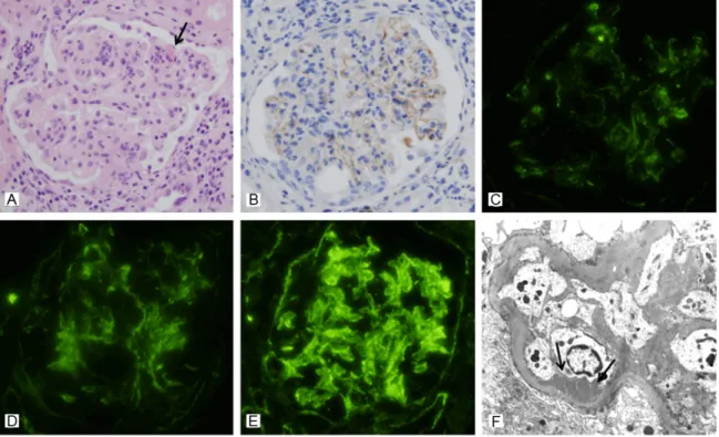 Figure 2. A representative renal biopsy specimen showing activation of the classical pathway in lupus nephritis  (case No