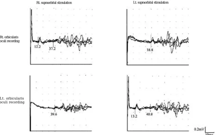 Figure 3. Blink test shows prolonged ipsilateral R1&amp;ipsilateral R2 in LSLR( Lt. supraorbital stimulation- Lt