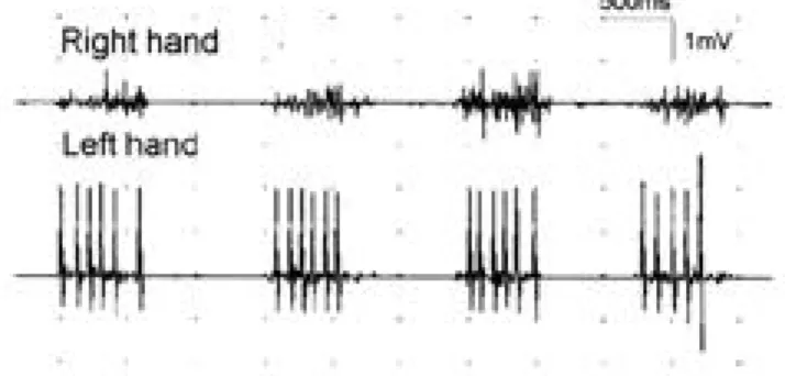 Figure 1. Simultaneous recording of both first dorsal interossei muscles during abduction of left index finger