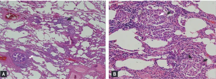 Figure 2. High resolution computed tomography view of the  chest reveals diffuse ground-glass opacities throughout both  lungs (white arrow) and centrilobular nodules (yellow arrows).