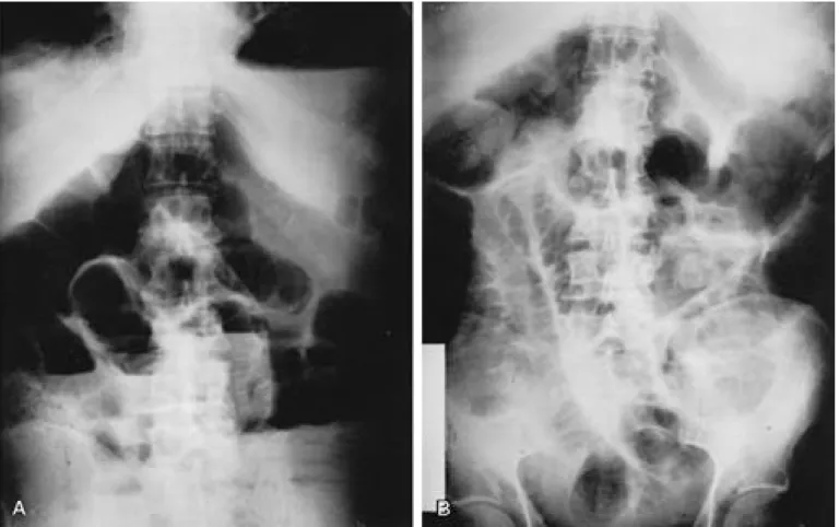 Figure 1. Simple Abdomen of Case 1 shows paralytic ileus with dilated colon.