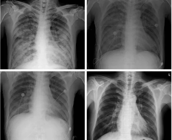 Fig. 1. Chest Radiograph during hospital stay. Chest radiograph showed diffuse patch infiltration in both lung field on admis- admis-sion day (left upper)