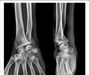 Figure 3 An intraoperative photograph shows extensor digiti minimi, as well as the fourth and fifth extensor digitorum communis tendons, are ruptured with fraying of the tissue in the ruptured margin