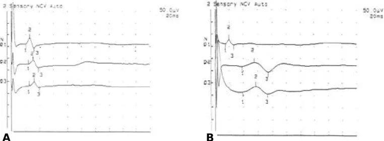 Figure 3. Sensory nerve action potential recorded by bar electrode in the digit 1(D1), digit 2(D2), digit 3(D3) of the normal control(A) and the carpal tunnel syndrome patient(B).