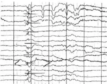 Figure 3. Schematic representation of precipitating processes and EEG and clinical expressions in praxis-induced epilepsy.