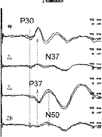Figure 2. Posterior tibial nerve somatosensory evoked potential during active contraction in normal subject.
