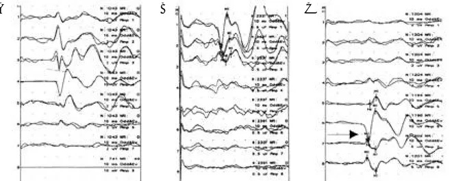 Figure 2. Cortical waves of PTSEP on subdural electrodes in mesial hemisphere around paracentral lobule
