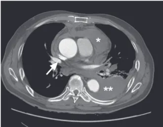 Fig. 1  Preoperative computed  tomogram shows a distal arch  aneurysm, measuring 65 mm  in diameter, at the level of the  right superior pulmonic vein  (arrow).