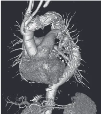 Fig. 3  Follow-up computed tomogram at 4 months shows a  well-seated stent-graft with no endoleak.