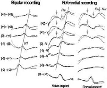 Figure 2. The differences of near field potential(N20) and far field potentials(P9,N10,P11,N12,P13) in scalp-scalp montage and scalp-noncephalic montage.