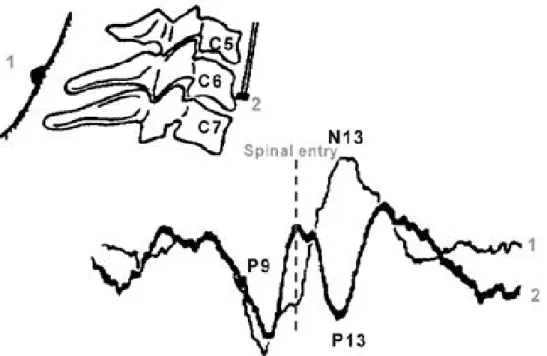 Figure 10. Somatosensory evoked potential to right median nerve stimulation.