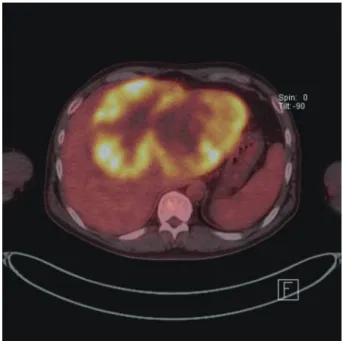Fig. 1. Computed tomography shows a very large hypoattenuating 