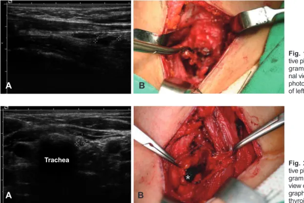 Fig. 3. This pathologic picture shows local recurrence of the tumor. 