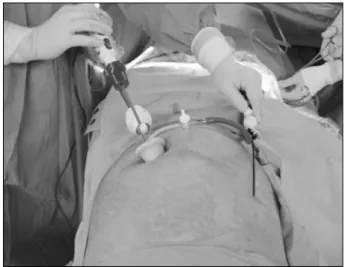 Fig.  1.  External  view  of  needlescopic  grasper  assisted  SILC  (nSILC)  procedure.