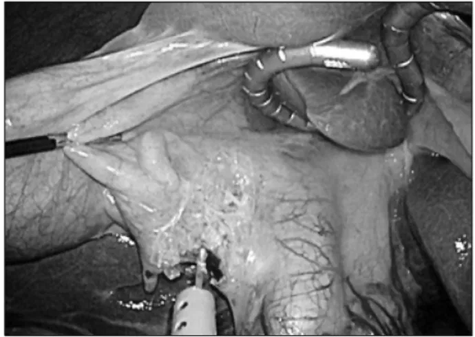 Fig.  2.  Internal  view  of  needlescopic  grasper  assisted  SILC  (nSILC)  procedure  using  snake  liver  retractor.