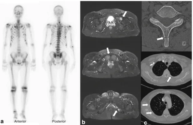 Fig. 1 A 44-year-old man presented with a 6-month history of diffuse musculoskeletal pain in the chest, back and both knees without antecedent trauma