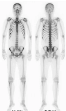 Fig. 2 A 42-year-old man who had taken adefovir dipivoxil (ADV) (10 mg/day) for 7 years for treatment of chronic hepatitis B complained of a 2-year history of diffuse musculoskeletal pain in the anterior chest area with absence of antecedent trauma