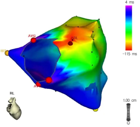 Figure 5. Three dimensional mapping system (Carto, BiosenseWebster) image of the right-sided chambers showing the successful site of ablation of the manifest right anterior accessory pathway in a patient 5