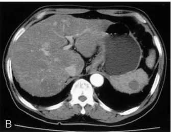 Figure  3.  Microscopic  examination  of  the  liver  biopsy  specimen  shows  interanastomosing  vascular  channels  lined  by  the  atypical  endothelial  cells  with  hyperchromatic  nuclei  line  (H&amp;E  stain