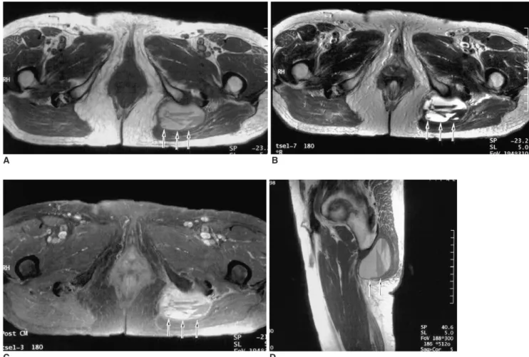 Fig. 2. Ischiogluteal bursitis in 71-year-old man.