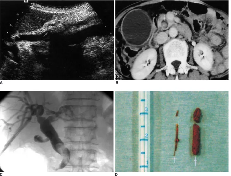 Fig. 1. A 75-year-old woman with common bile duct stone.