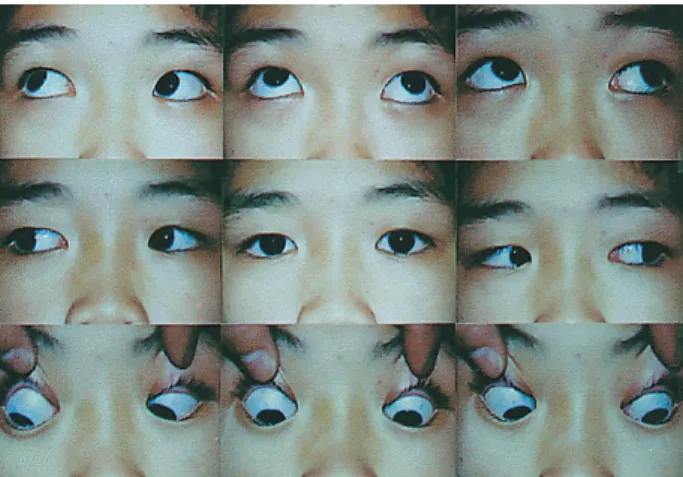 Figure 2. Prism and cover test in 9 diagnostic position at distance.