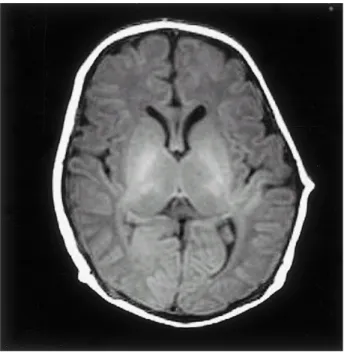 Figure 3. Brain MRI show the sclerotic change of optic canal (large arrow) and crooked pathway of optic nerve (small arrow) is seen.