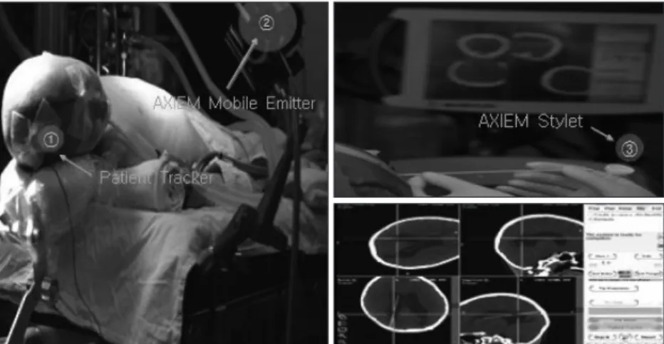 Fig. 1. The operation with electromagnetic navigation system. A noninvasive dynamic reference  frame applied to the scalp is shown to identify the location of anatomy within the frame of  refer-ence