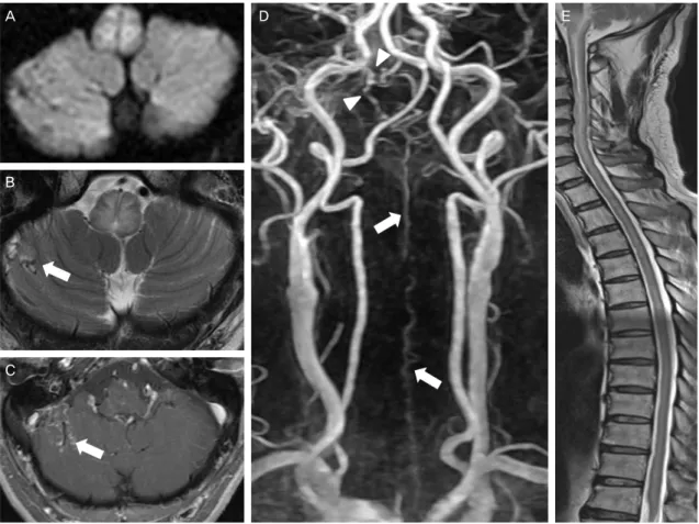 Figure 1. MR images of the patient. There are bilateral hyperintense lesions in the medulla on diffusion weighted image (A), which  means vasogenic edema