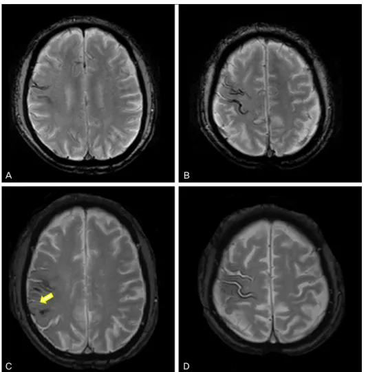 Figure 1. Axial gradient echo T2-  weighted MRI showing features of  superficial siderosis of the central  nervous system