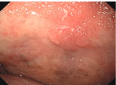 Table 2. Reflux Finding Score Subglottic edema Ventricular