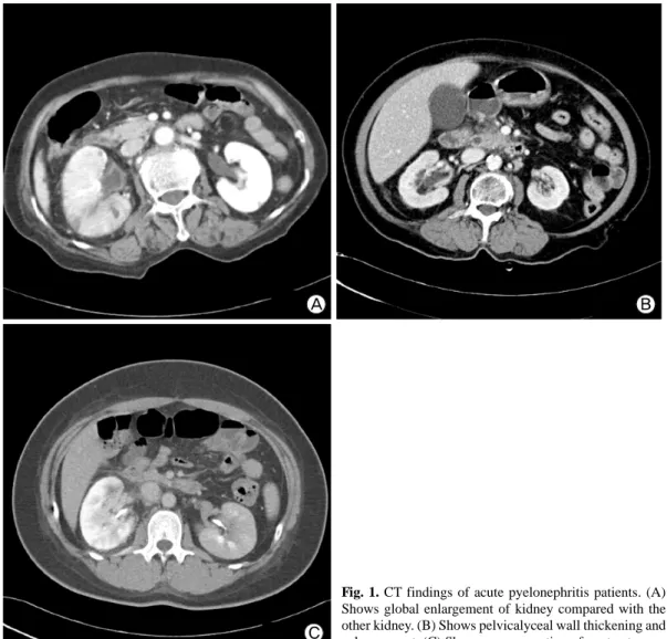 Fig. 1. CT findings of acute pyelonephritis patients. (A)  Shows global enlargement of kidney compared with the  other kidney
