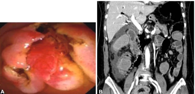 Fig. 2. Images of the inserted stent. (A) Duodenoscopic finding showing the inserted covered-stent at ampulla of vater