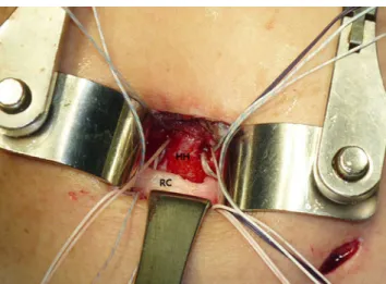Fig. 3 The torn tendon was repaired anatomically with the double- double-row technique using suture anchors