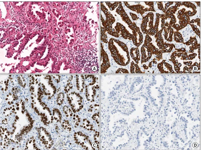 Figure 4. The computed tomography-guided percutaneous needle biopsy specimens of the right lung nodule