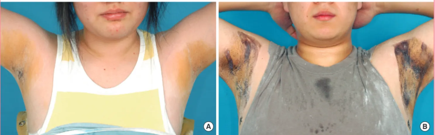 Fig. 1. Preoperative iodine starch test (Minor’s test)