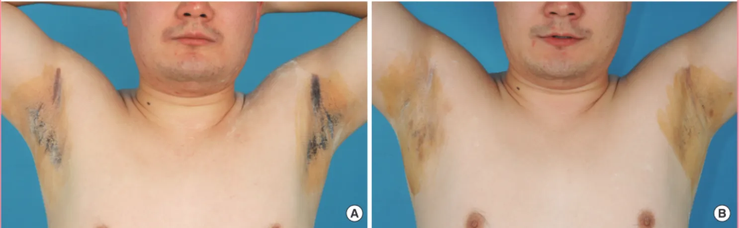 Fig. 6. The postoperative iodine starch test (Minor’s test) 