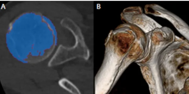 Fig.  2와  같이  실험에  사용된  장치로는  640  Multislice  CT(Aquilion  ONE,  Toshiba,  Japan),  5축  가공  장치(RXP  600  DSH,  Roders  GmbH,  Germany)을  사용하였으며,  위 팔뼈에  대한  DICOM  영상  및  변환  모델링은  Terarecon  (AquariusNET,  TERARECON,  USA),  Mimics  (innovation  suite  v