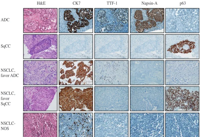 Fig. 1.   Diagnosis and subclassification of nonsmall cell lung carcinoma according to 2011 IASLC/ATS/