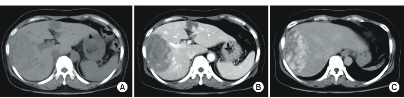 Fig.  2.  (A,  B,  C)  Magnetic  resonance  imaging  (MRI)  showed  a  large  mass  as  moderately  hypointense  on  T1-weighted  image,  (D,  E,  F)  black  on  T2-weighted  image,  and  gradually  nodular  enhanced  on  dynamic  study.