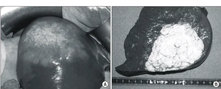 Fig.  4.  Microscopic  findings  of  sclerosed  hemangioma.  (A)  Diffusely  proliferation  of  collagenous  tissue  with  hyalinization  around  and  between  numerous  sclerotic  vessels  (H&amp;E  stain,  ×40)