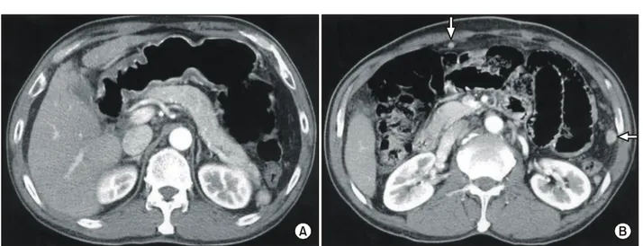 Fig.  2.  Gross  finding  was  1×1  cm  sized  multiple  splenules  which  located  on  greater  omentum.