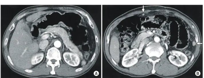 Fig.  2.  Gross  finding  was  1×1  cm  sized  multiple  splenules  which  located  on  greater  omentum.