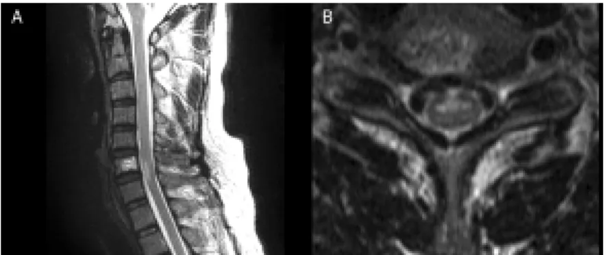 Figure 1. (A) Sagittal T2- weighted spinal MRI  shows hyperintensity extending from segments C6  to C7